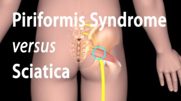 Piriformis Syndrome or Sciatica? The Surprising Truth Behind Your Pain!