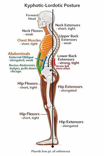 Diagram of kyphotic-lordotic posture showing a forward head, tight chest and hip flexors, and elongated hip extensors.